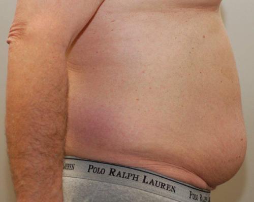 Male Body Contouring Patient Photo - Case 20 - before view-1