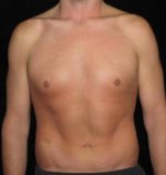 Male Body Contouring - Case 27 - After
