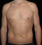 Male Body Contouring - Case 27 - Before