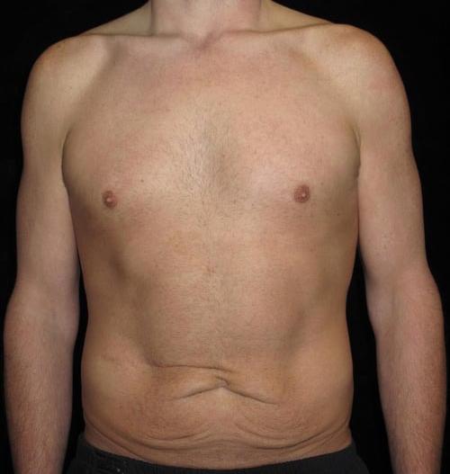 Male Body Contouring Patient Photo - Case 27 - before view-