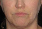 Botox - Case 4 - Before