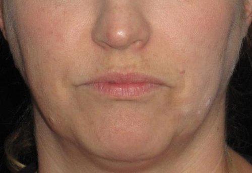 Botox Patient Photo - Case 4 - before view-