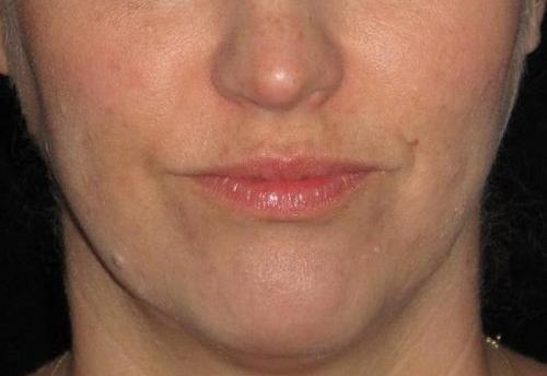 Botox Patient Photo - Case 4 - after view