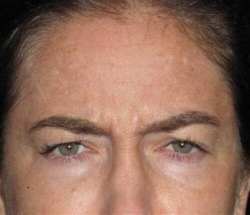 Botox Patient Photo - Case 14 - before view-
