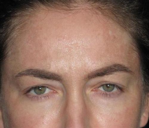 Botox Patient Photo - Case 14 - after view