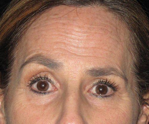 Botox Patient Photo - Case 2 - before view-1
