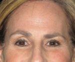 Botox - Case 2 - After