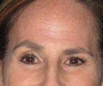 Botox - Case 2 - Before