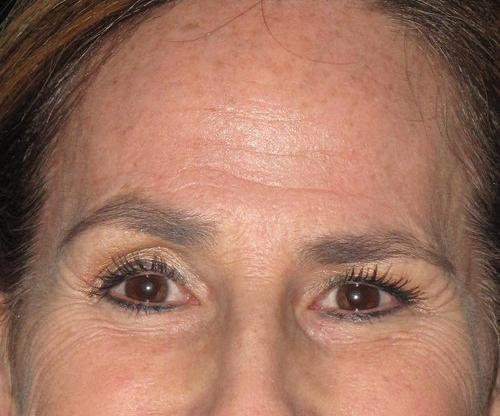 Botox Patient Photo - Case 2 - before view-