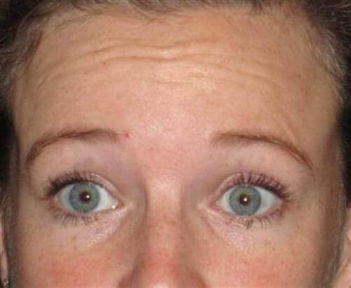 Botox Patient Photo - Case 16 - before view-0