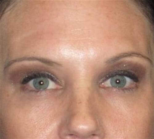 Botox Patient Photo - Case 10 - after view-1
