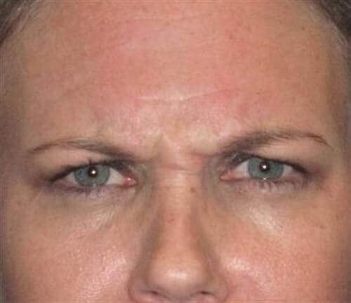 Botox Patient Photo - Case 10 - before view-0