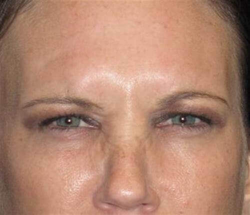 Botox Patient Photo - Case 10 - after view-0
