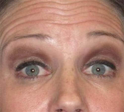 Botox Patient Photo - Case 10 - before view-1