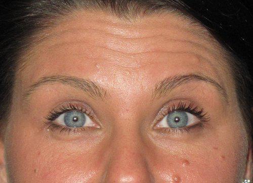 Botox Patient Photo - Case 19 - before view-0