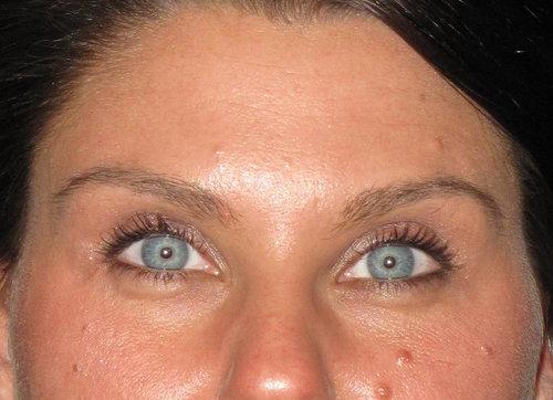 Botox Patient Photo - Case 19 - after view