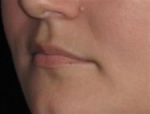 Dermal Fillers Patient Photo - Case 15 - before view-1