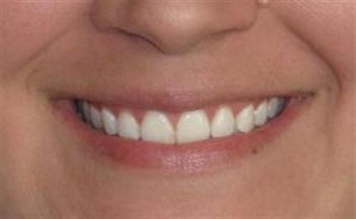 Dermal Fillers Patient Photo - Case 15 - before view-