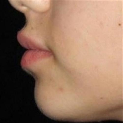 Dermal Fillers Patient Photo - Case 13 - after view-1