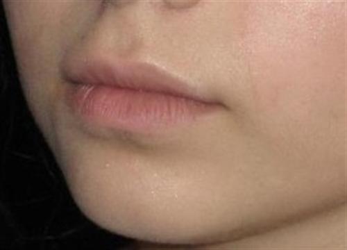 Dermal Fillers Patient Photo - Case 13 - before view-