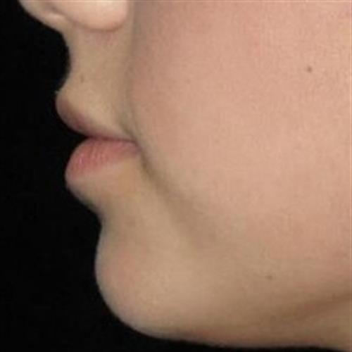 Dermal Fillers Patient Photo - Case 13 - before view-1