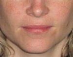 Dermal Fillers - Case 17 - After