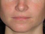 Dermal Fillers - Case 17 - Before