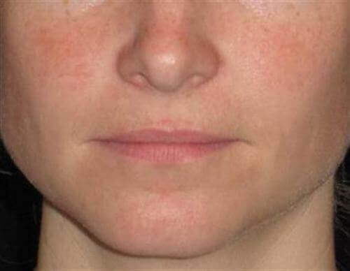Dermal Fillers Patient Photo - Case 17 - before view-
