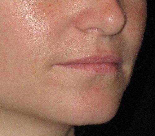 Dermal Fillers Patient Photo - Case 17 - before view-1