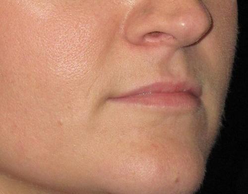 Dermal Fillers Patient Photo - Case 18 - before view-1