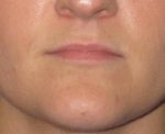 Dermal Fillers - Case 18 - Before