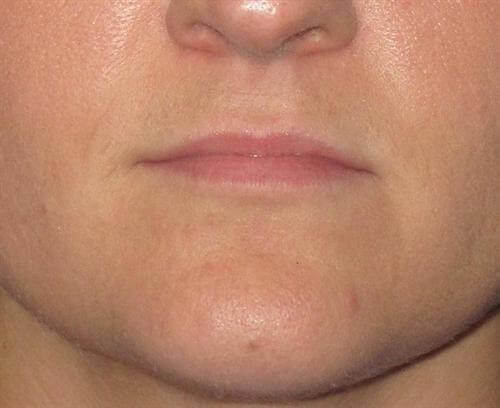 Dermal Fillers Patient Photo - Case 18 - before view-