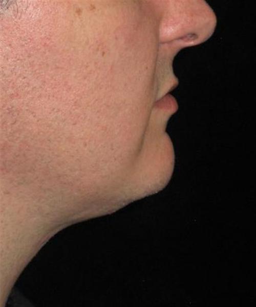KYBELLA® Patient Photo - Case 162 - after view-0