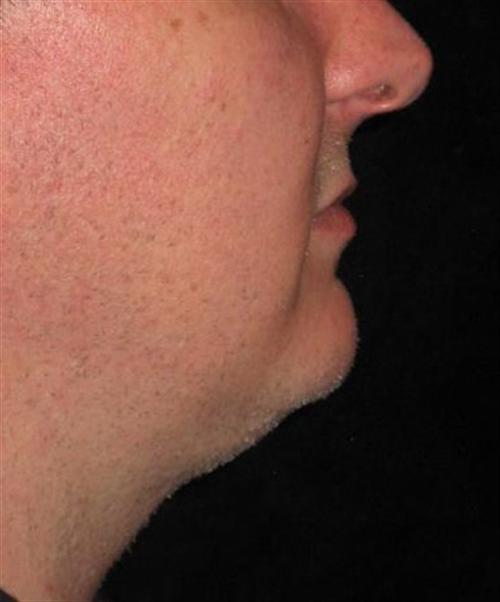 KYBELLA® Patient Photo - Case 162 - before view-