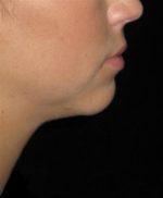 KYBELLA® - Case 161 - After