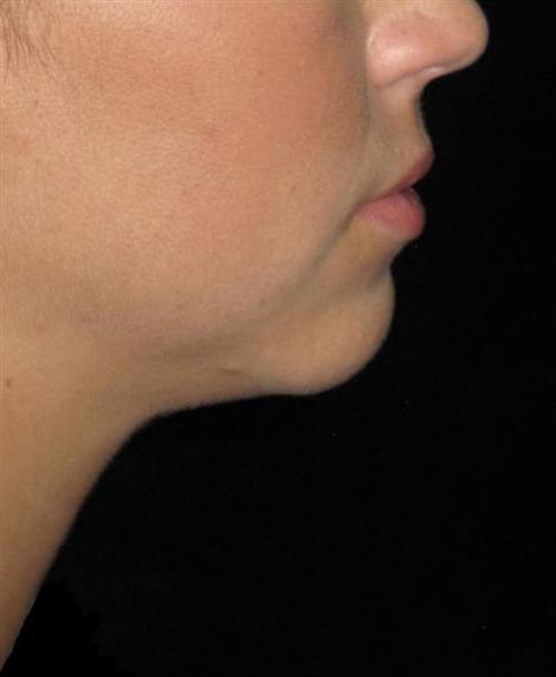 KYBELLA® Patient Photo - Case 161 - after view