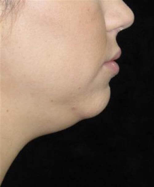 KYBELLA® Patient Photo - Case 161 - before view-