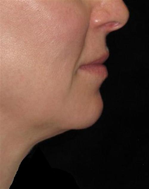 KYBELLA® Patient Photo - Case 55 - after view
