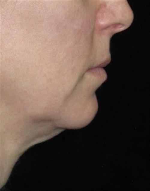 KYBELLA® Patient Photo - Case 55 - before view-