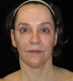 Laser Services - Case 5 - Before