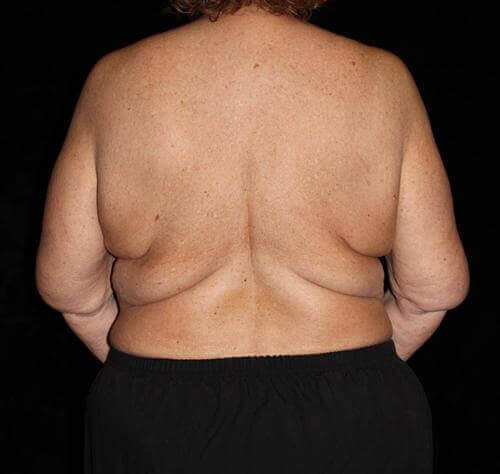 Body Lift Patient Photo - Case 177 - before view-