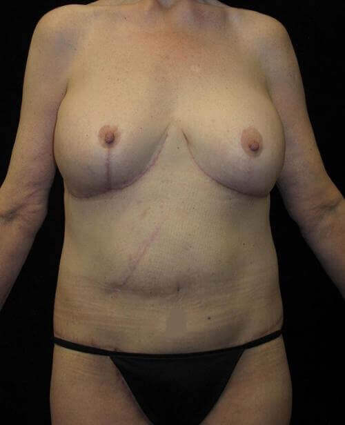 Body Lift Patient Photo - Case 68 - after view