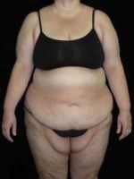 Body Lift - Case 58 - Before