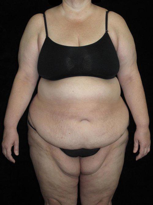 Body Lift Patient Photo - Case 58 - before view-