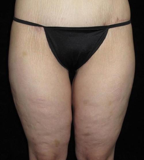 Body Lift Patient Photo - Case 71 - after view-2