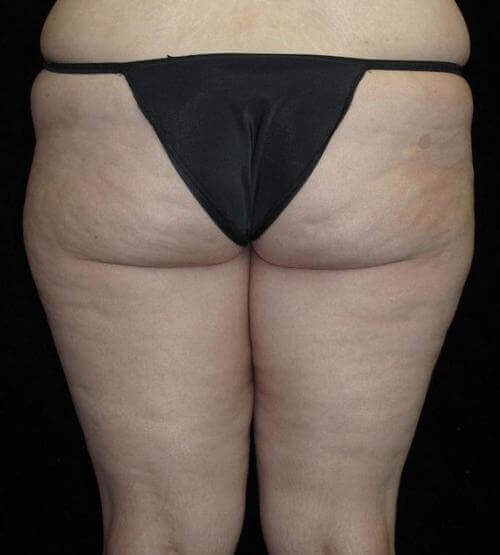 Body Lift Patient Photo - Case 71 - before view-3