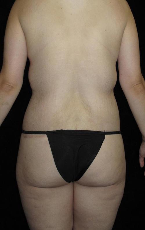 Body Lift Patient Photo - Case 71 - after view-1