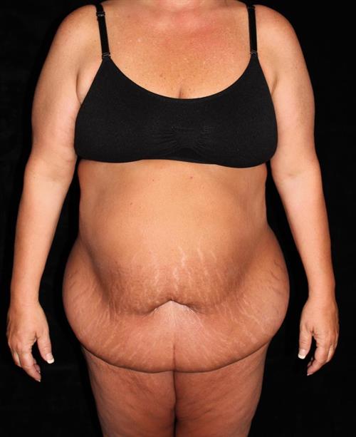 Body Lift Patient Photo - Case 226 - before view-