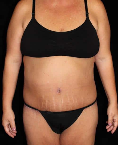 Body Lift Patient Photo - Case 226 - after view