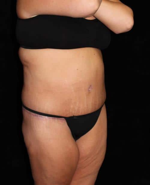 Body Lift Patient Photo - Case 226 - after view-1